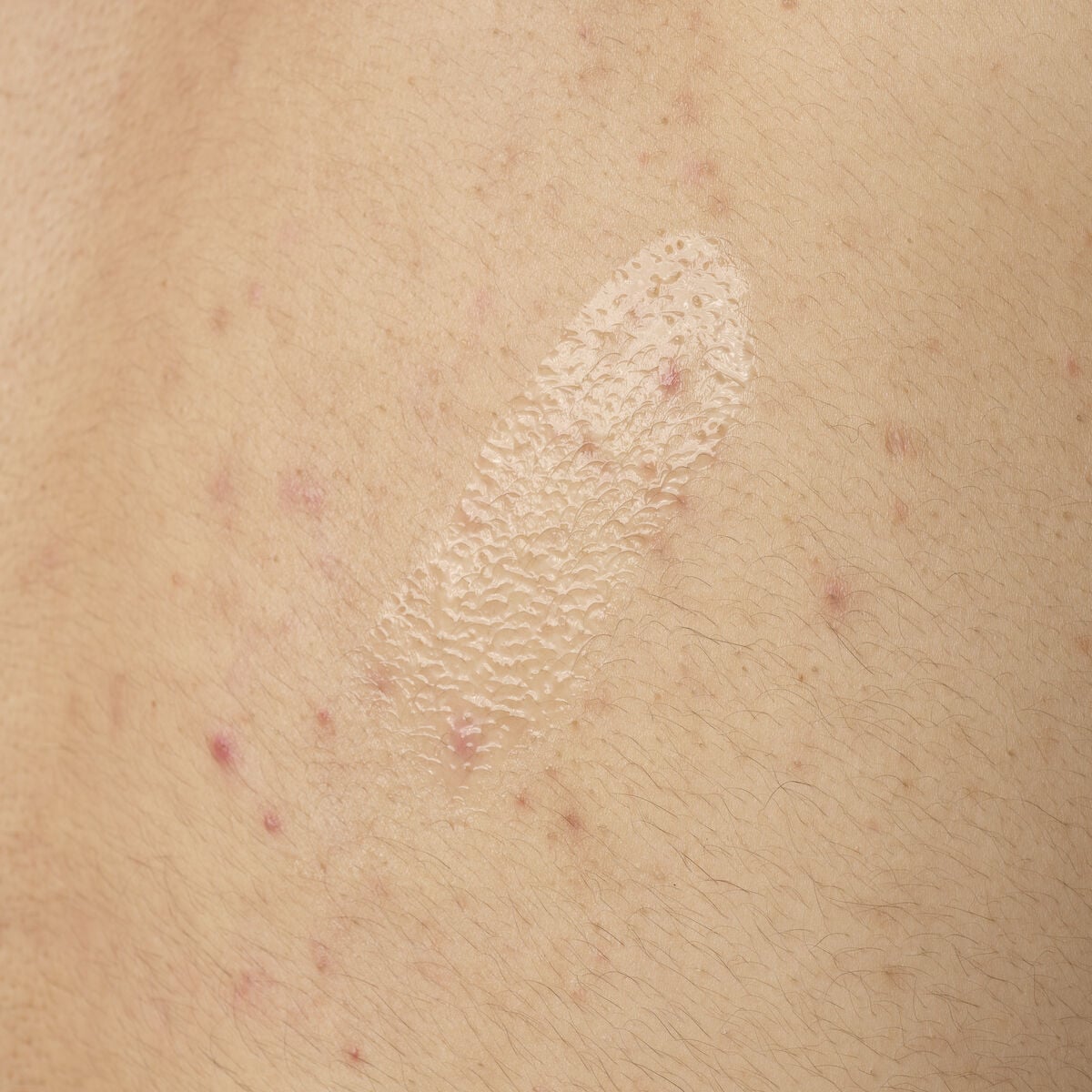 salicylic-acid-0-5-body-serum-g1 ORD-salicylic-acid-05-body-240ml-application.jpg