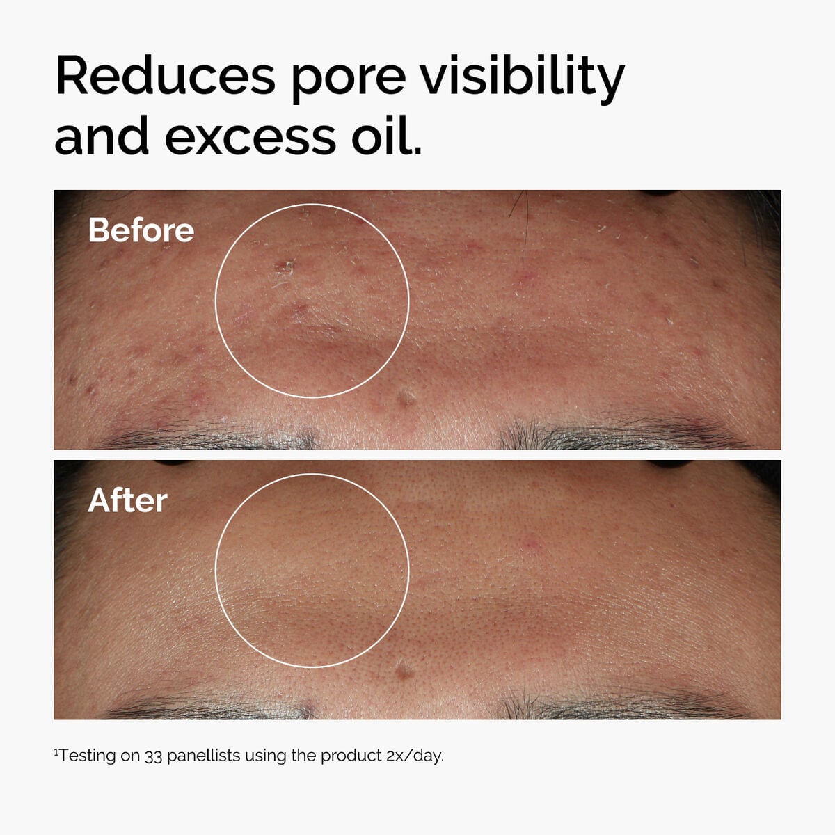 niacinamide-10-zinc-1-x1 ord-niacinamide-zinc-blemish-serum-before-after-pores.jpg