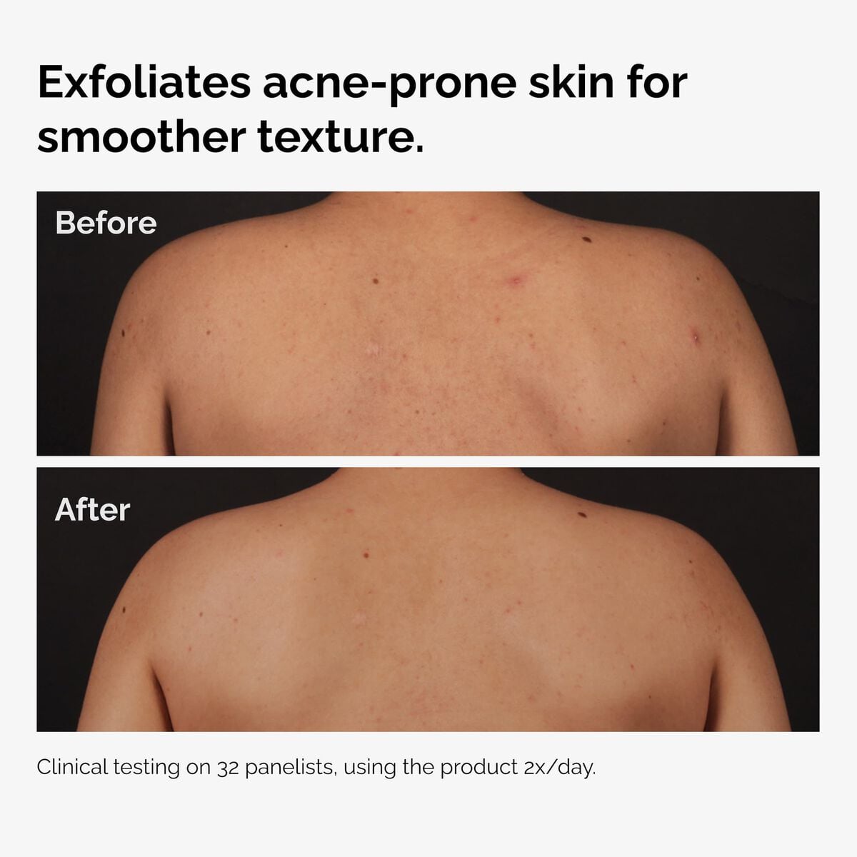 salicylic-acid-0-5-body-serum-g1 ord-salicylic-acid-body-serum-before-after-graphic-NA.jpg