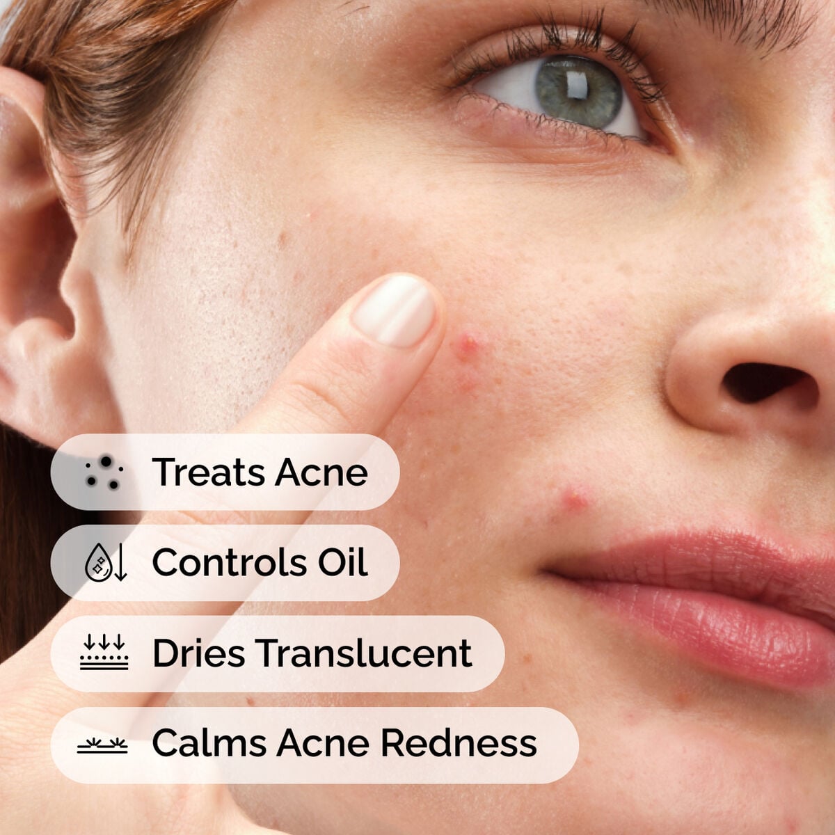 sulfur-10-powder-to-cream-concentrate-q3 ord-sulfur-10pct-powder-to-cream-concentrate-model-application-with-benefits-acne.jpg