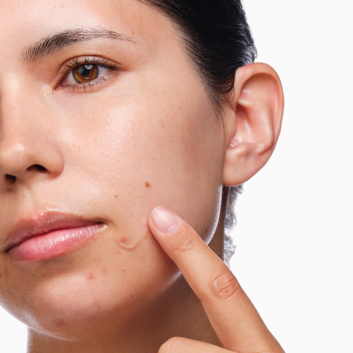 the-acne-set-u2 rdn-the-acne-set-application.png